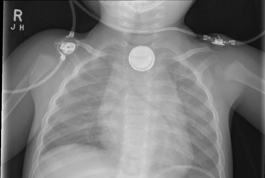 Button Battery Safety Tasmanian Times