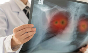 Key Findings in Burden of Disease Study 17