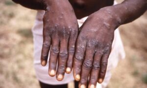WHO Advice on Monkeypox 8