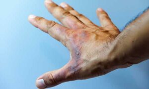 Mitigating the Risk of Burns this Winter 21