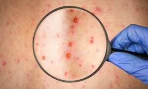 Measles Case Identified in Launceston 5