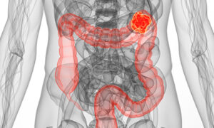 Long 235 Day Wait for a Colonoscopy in Tasmania 7