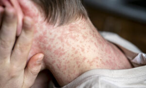 Measles Risk - Check Your Vaccinations Now 5