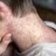 Measles Risk - Check Your Vaccinations Now 6