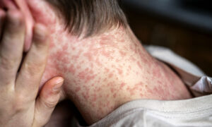 Third Measles Case Linked To Previous Southern Infection 4