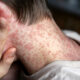Third Measles Case Linked To Previous Southern Infection 5
