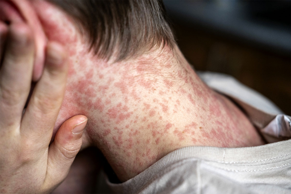 Third Measles Case Linked To Previous Southern Infection 1