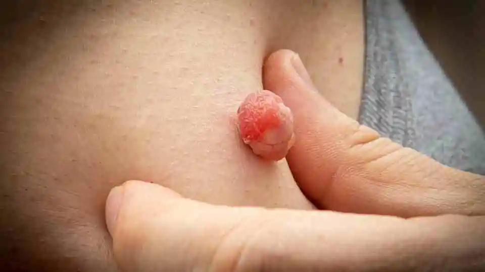 Affordable Home Removal of Skin Tags Solutions 3 Affordable Home Removal of Skin Tags Solutions 3